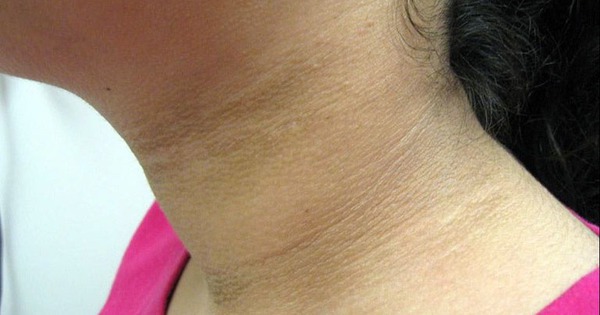 Dấu hiệu nguy hiểm nhất của bệnh tiểu đường hóa ra không phải khát nước hay tiểu nhiều, tôi đã rất hối hận vì bỏ qua bất thường này