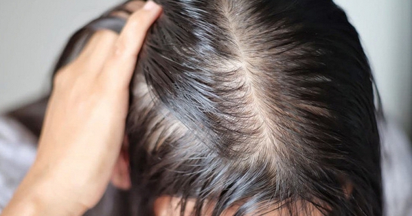 Lời khuyên cho những người hay bị rụng tóc