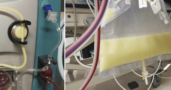 Bé gái 12 tuổi cấp cứu trong tình trạng máu trắng đục, nhớt như mỡ lợn, bác sĩ trách bố mẹ: Chiều kiểu hại con!