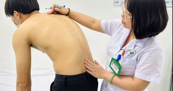 Tưởng đau lưng do tập gym, chàng trai 20 tuổi mắc viêm cột sống dính khớp