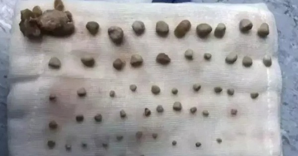 Ngỡ ngàng lấy ra 56 viên sỏi trong thận bé trai lớp 4, bác sĩ nói thẳng: Bố mẹ chiều sai cách!