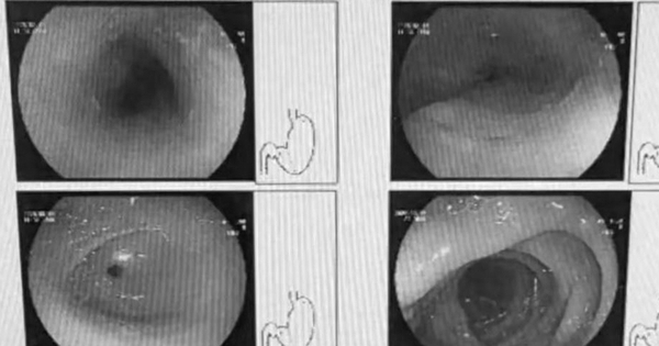 Người phụ nữ 42 tuổi loét thực quản vì thói quen ăn lẩu 