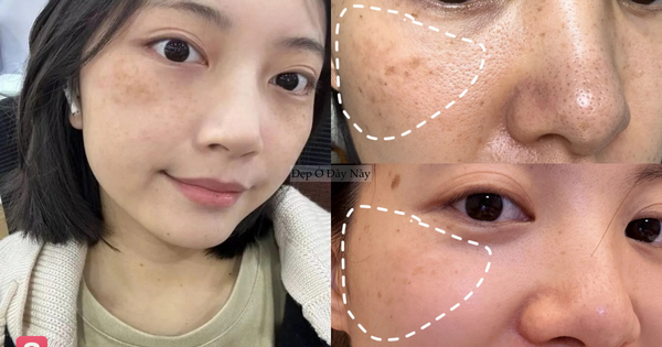 Tiến sĩ da liễu tiết lộ 5 cách giảm thâm nám tại nhà nhiều người bỏ qua