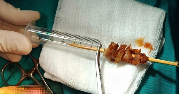 Cuộc hội chẩn xuyên đêm cứu bé gái gặp tai nạn hi hữu do que xiên thịt