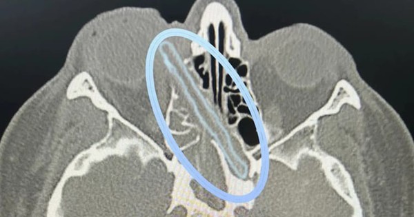 Đau nhói mắt trái, người đàn ông 50 tuổi sốc nặng khi bác sĩ gắp ra thứ 