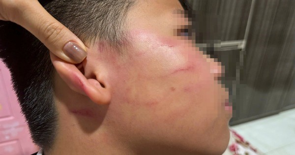 Vụ giáo viên nước ngoài tát học sinh: Gia đình nói bé trai bị thủng màng nhĩ