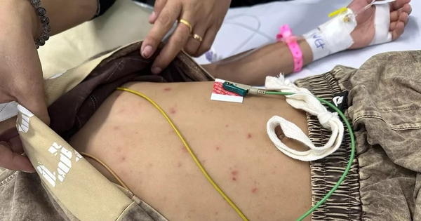 Bé trai mắc não mô cầu thoát chết nhờ phát hiện nốt ‘tử ban’ trên da