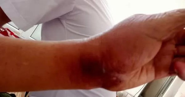 Cảnh báo nguy cơ nhiễm trùng, nhiễm độc nặng khi tiếp xúc với côn trùng độc