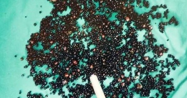 Đau bụng suốt nhiều tháng, người đàn ông 43 tuổi sốc nặng khi bác sĩ gắp ra thứ 