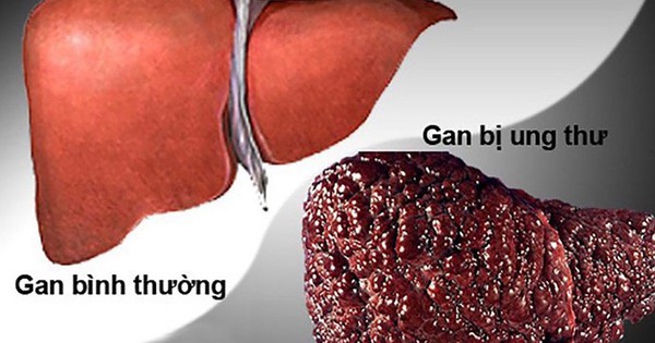 Người thuộc nhóm nguy cơ cao mắc ung thư gan cần l