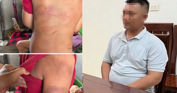 Vụ bé trai 10 tuổi người thâm tím nghi bị bạo hành