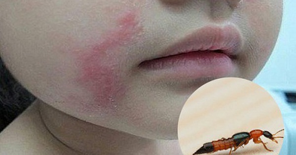 Bác sĩ BV Bạch Mai cảnh báo căn bệnh viêm da do một loại côn