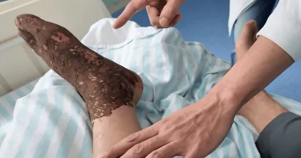 Bị rắn độc cắn khi đang cấy lúa, người đàn ông làm