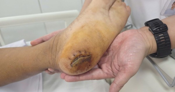 Bệnh viện Bạch Mai cảnh báo: Nhiều người đang phải nhập viện thở máy vì 1 căn bệnh do chủ quan vết thương nhỏ