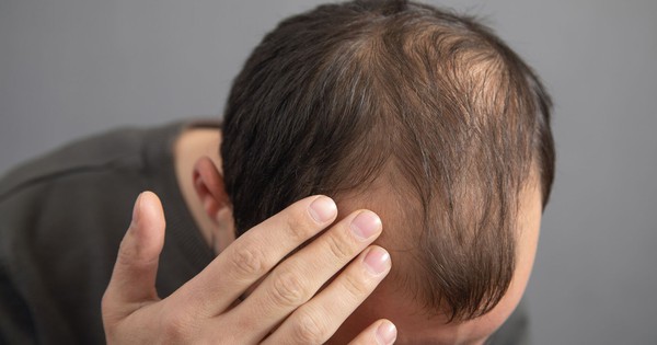 Thường xuyên ăn 5 món này, đừng trách vì sao tóc rụng lả tả