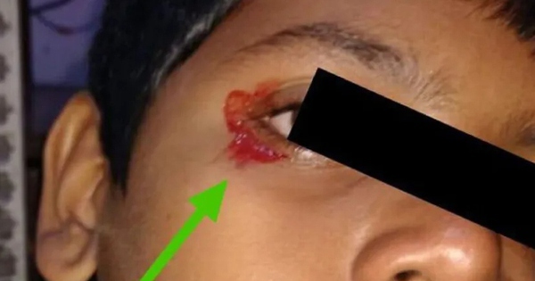 Bé trai 11 tuổi khóc ra máu khiến bác sĩ kinh ngạc