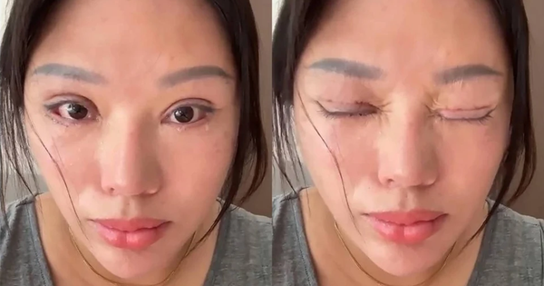 Người phụ nữ 6 năm không thể nhắm mắt khi ngủ, lý do phía sau khiến nhiều người bất ngờ