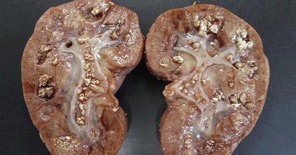 Người phụ nữ 58 tuổi thận bám đầy mủ, suýt mất thận: BS cảnh