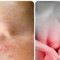 Những triệu chứng suy thận nhẹ bạn cần biết