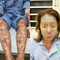 Dùng “thuốc giảm mỡ bụng, collagen”, người phụ nữ ở TP.HCM nguy kịch: Rùng mình hình ảnh tổn thương da khắp cơ thể