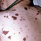 TP.HCM ghi nhận thêm 1 ca mắc viêm não mô cầu