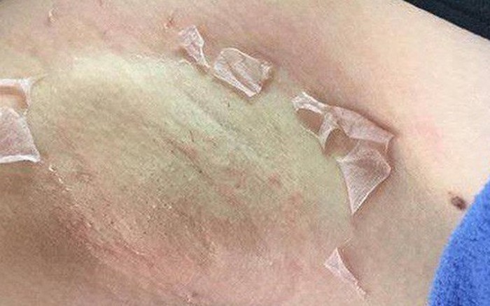 Dùng liệu trình tẩy thâm nách theo tư vấn, cô gái trẻ bất ngờ khi nhìn vào lớp da sau khi lột