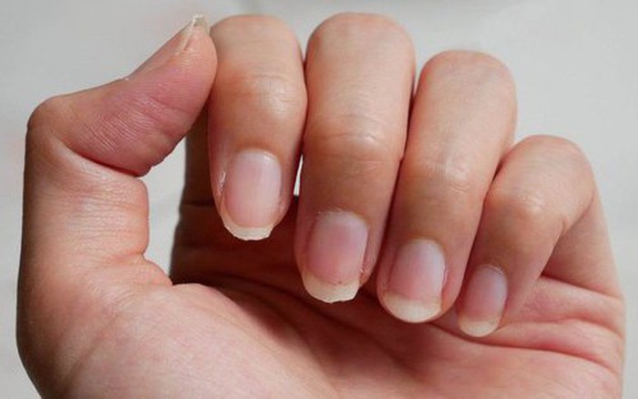 4 dấu hiệu ở móng tay cảnh báo các vấn đề sức khỏe đáng lưu ý