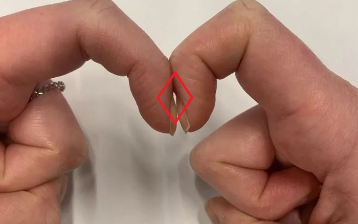 Bài kiểm tra 5 giây đánh giá nguy cơ ung thư phổi: Ai thấy hình thoi thì có  thể yên tâm