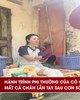 Hành trình phi thường của cô gái mất cả chân lẫn tay